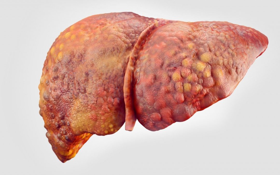 Λιπώδες ήπαρ: Παθογένεση και ο ρόλος των μιτοχονδρίων και του οξειδωτικού στρες