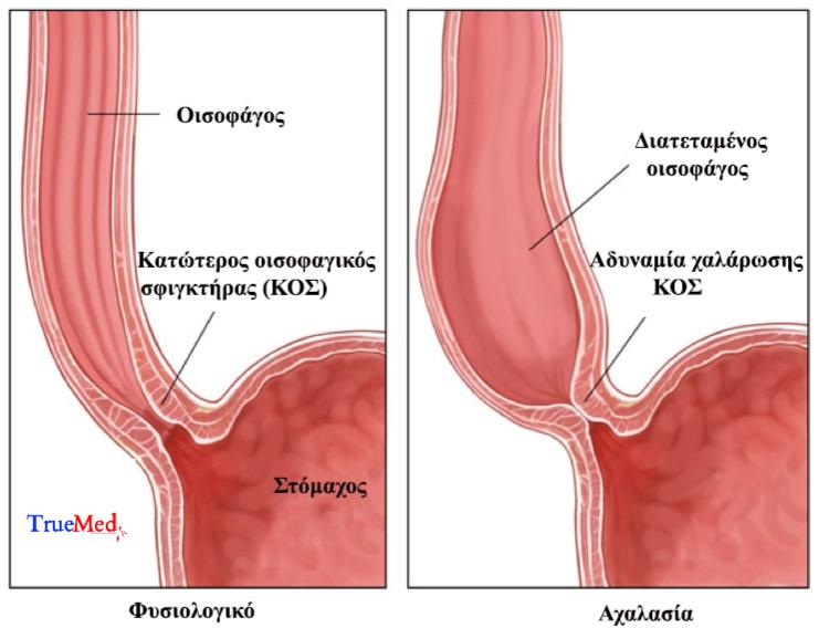 πονος στο στήθος 1
