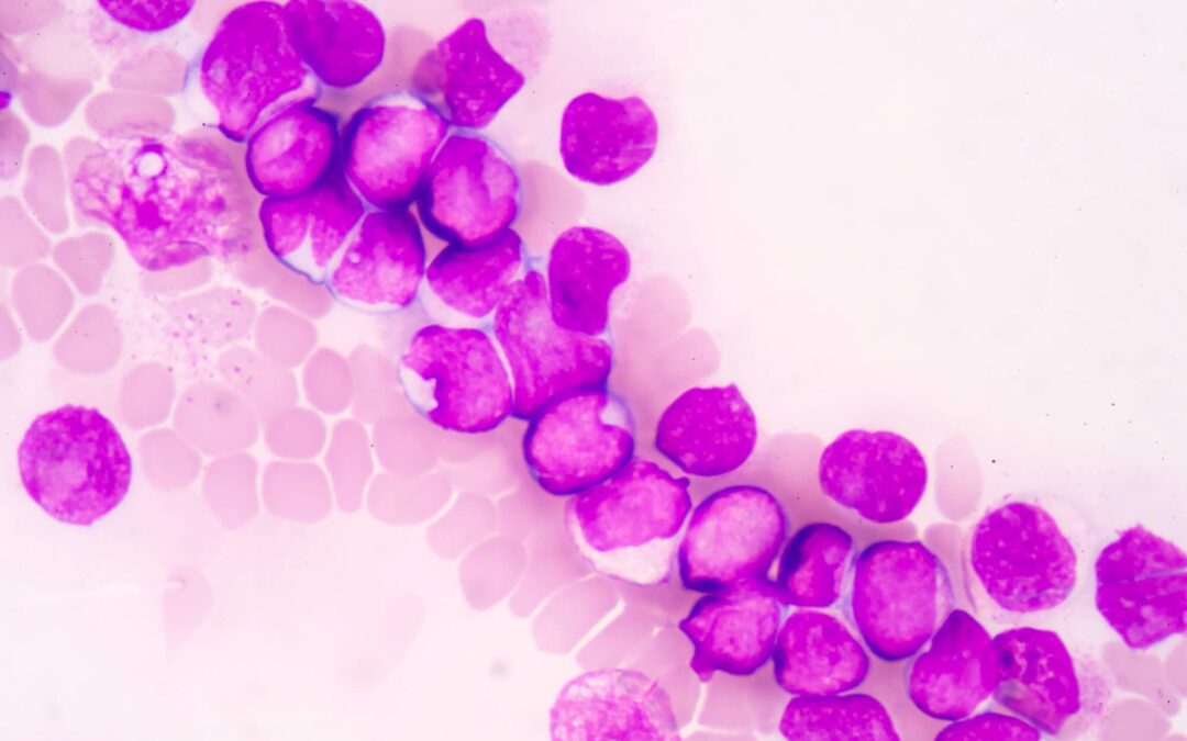 Παιδική Λευχαιμία: Συμπτώματα, τύποι, Διάγνωση και Θεραπεία