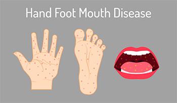 Τι είναι η νόσος χεριών, ποδιών, στόματος και όλα όσα πρέπει να γνωρίζετε