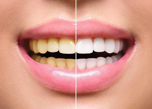 Όσα πρέπει να γνωρίζετε για τη λεύκανση των δοντιών