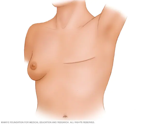 breast cancer 6
