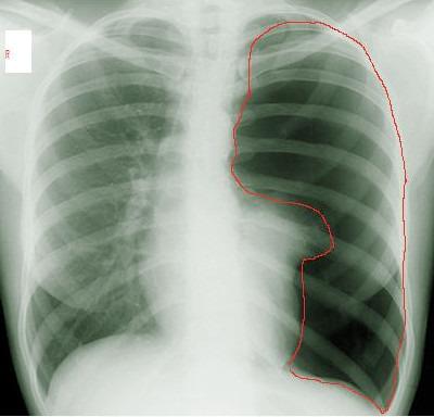 pneumothorax4